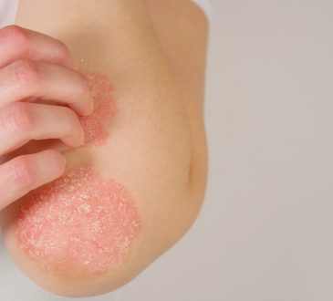 Ministerio de Salud aprobó medicamento para tratamiento de la psoriasis de la biofarmacéutica AbbVie