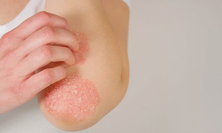 Ministerio de Salud aprobó medicamento para tratamiento de la psoriasis de la biofarmacéutica AbbVie