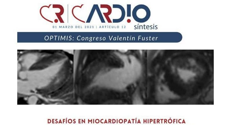 Cardiosíntesis publicó análisis sobre la miocardiopatía hipertrófica Cardiosíntesis publicó análisis sobre la miocardiopatía hipertrófica
