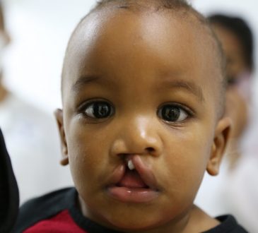 Hospital Gautier y Operación Sonrisa harán dos jornadas de cirugía pediátrica