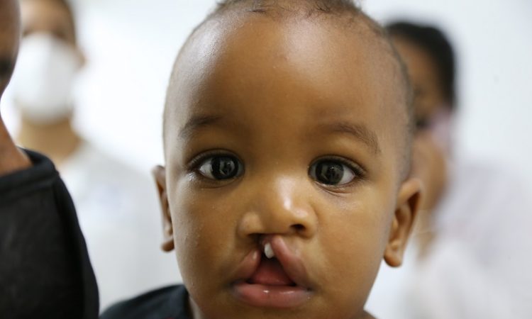 Hospital Gautier y Operación Sonrisa harán dos jornadas de cirugía pediátrica
