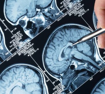 Especialista dio a conocer fármacos novedosos para controlar convulsiones por epilepsia