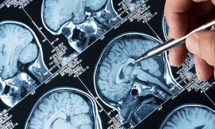 Especialista dio a conocer fármacos novedosos para controlar convulsiones por epilepsia