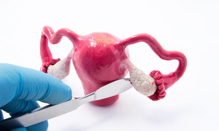 AstraZeneca y MSD presentaron tratamiento que reduce el 70% del avance en cáncer de ovarios