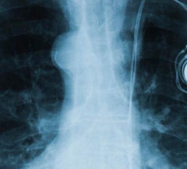 FDA recomendó tomar precaución con ciertos dispositivos electrónicos a personas con marcapasos y desfibriladores implantables