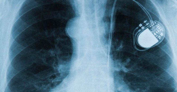 FDA recomendó tomar precaución con ciertos dispositivos electrónicos a personas con marcapasos y desfibriladores implantables FDA recomendó tomar precaución con ciertos dispositivos electrónicos a personas con marcapasos y desfibriladores implantables