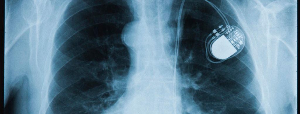 FDA recomendó tomar precaución con ciertos dispositivos electrónicos a personas con marcapasos y desfibriladores implantables