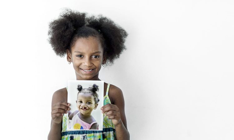 Operación sonrisa beneficiará a 25 niños con su vigésimo octava misión médica