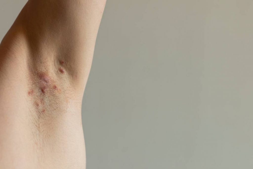 AbbVie alertó sobre las precauciones para prevenir y tratar la Hidradenitis Supurativa