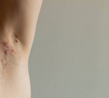 AbbVie alertó sobre las precauciones para prevenir y tratar la Hidradenitis Supurativa