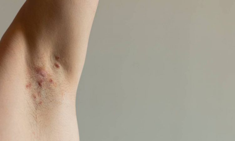 AbbVie alertó sobre las precauciones para prevenir y tratar la Hidradenitis Supurativa AbbVie alertó sobre las precauciones para prevenir y tratar la Hidradenitis Supurativa