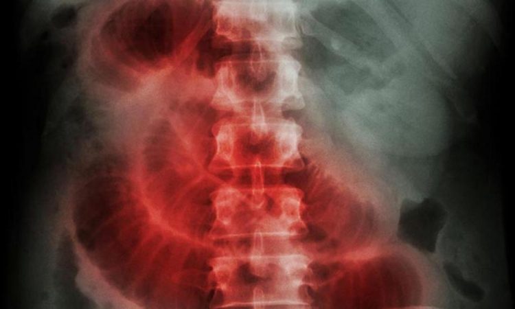 Paciente dominicano con fístula intestinal y sepsis de alta complejidad fue remitido al Cleveland Clinic Paciente dominicano con fístula intestinal y sepsis de alta complejidad fue remitido al Cleveland Clinic