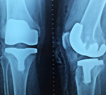 IOF: La osteoporosis provoca una fractura cada tres segundos en el mundo