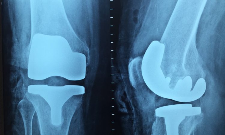 IOF: La osteoporosis provoca una fractura cada tres segundos en el mundo