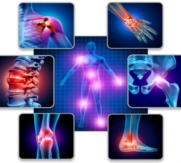 Viscosuplementación, la solución para tratar efectivamente la osteoartritis en todas sus fases