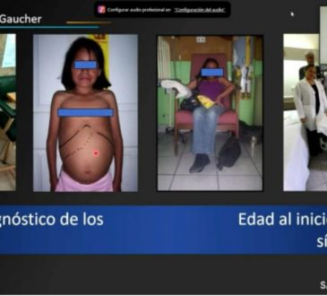 Especialista destaca importancia de detección temprana y certera de la enfermedad de Gaucher