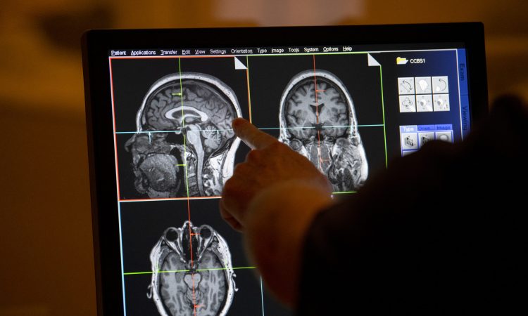 Cleveland Clinic lanza primer estudio cerebral para prevenir enfermedades neurológicas