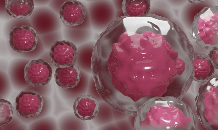 Trasplante con células madre cura a primera paciente con VIH en el mundo Trasplante con células madre cura a primera paciente con VIH en el mundo
