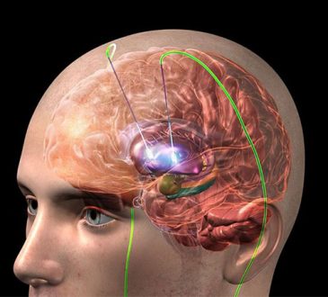 La estimulación cerebral profunda, cirugía para pacientes con Párkinson