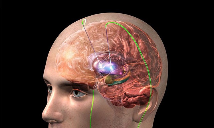 La estimulación cerebral profunda, cirugía para pacientes con Párkinson