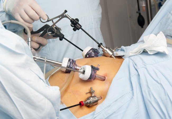 La cirugía bariátrica reduce el riesgo de sufrir enfermedades cardiovasculares, según estudio
