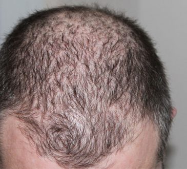 FDA aprueba uso del fármaco Olumiant contra la alopecia