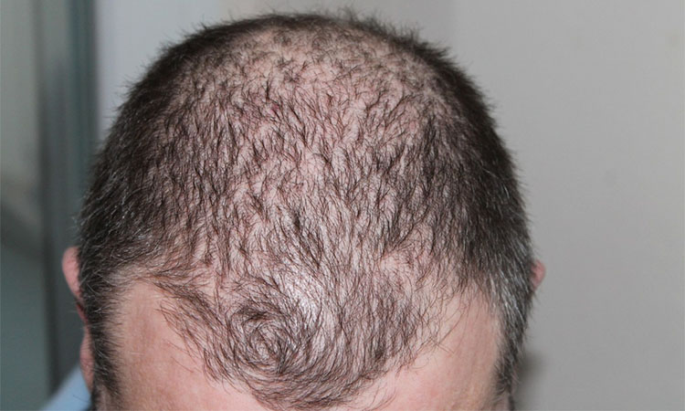 FDA aprueba uso del fármaco Olumiant contra la alopecia FDA aprueba uso del fármaco Olumiant contra la alopecia