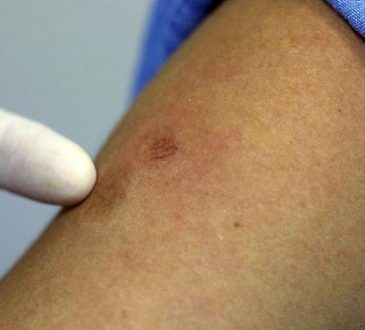 Salud Pública confirmó tres nuevos casos de viruela símica en el país