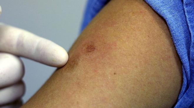 Paciente con viruela del mono en el país podría recibir el alta médica este fin de semana