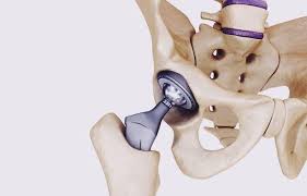 Ortopedas reclaman implantes aprobados por las ARS
