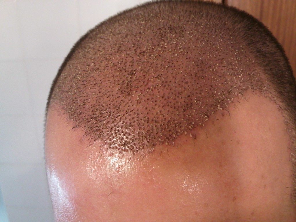 Dermatólogos alertan sobre expansión del mercado negro de trasplante capilar en RD