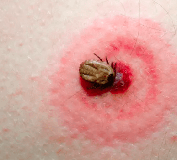 Enfermedad de Lyme