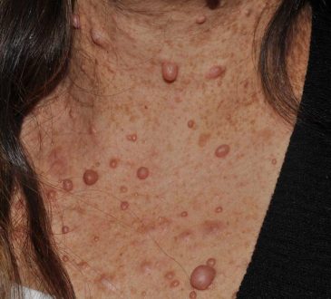 Neurofibromatosis tipo 1, trastorno hereditario que aumenta riesgo cancerígeno