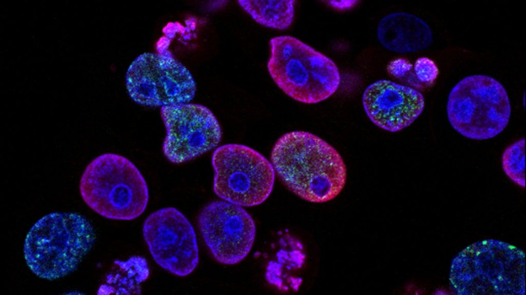 HER2+, el nuevo tratamiento que reduce los lapsos de recuperación del cáncer de mama