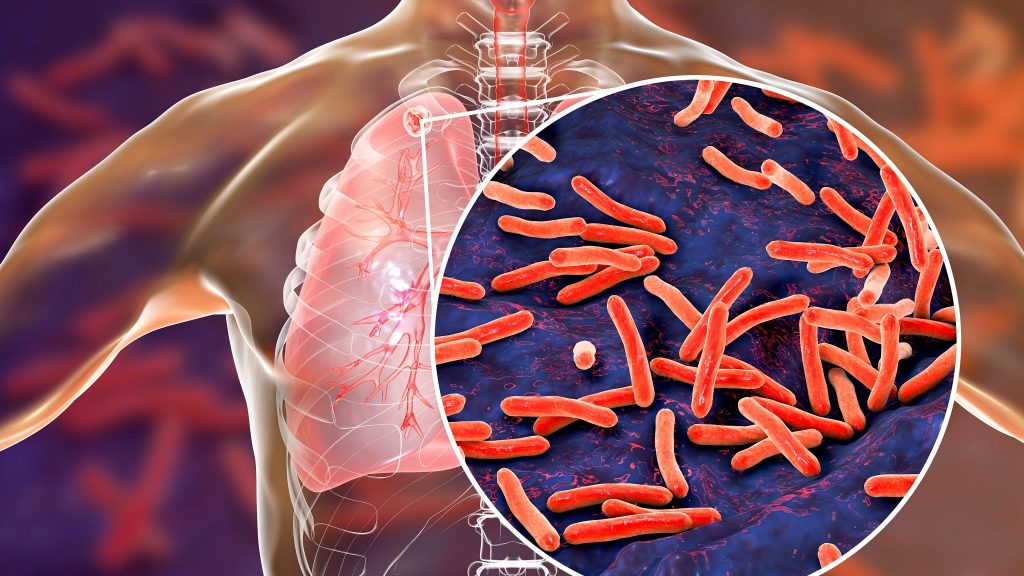 MSP confirma más de 1,000 casos activos de tuberculosis en el Gran Santo Domingo y Monte Plata
