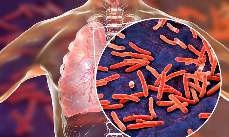 MSP confirma más de 1,000 casos activos de tuberculosis en el Gran Santo Domingo y Monte Plata