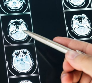 Red Pública garantiza atención hospitalaria a pacientes con epilepsia