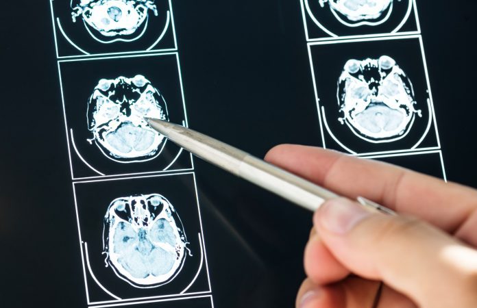 Red Pública garantiza atención hospitalaria a pacientes con epilepsia
