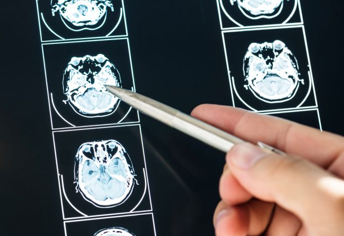 Red Pública garantiza atención hospitalaria a pacientes con epilepsia