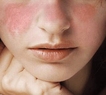Especialista alerta sobre incidencia del lupus en las mujeres