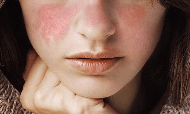Especialista alerta sobre incidencia del lupus en las mujeres
