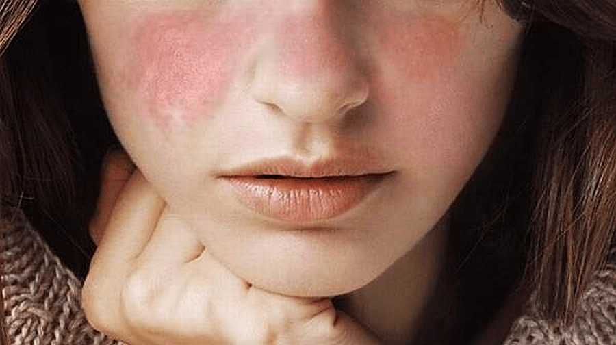 Especialista alerta sobre incidencia del lupus en las mujeres
