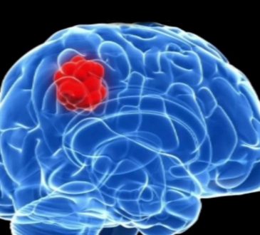 Expertos señalan carencia proteica como factor de riesgo del cáncer cerebral