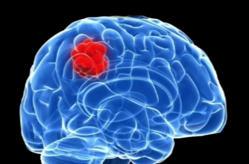 Expertos señalan carencia proteica como factor de riesgo del cáncer cerebral