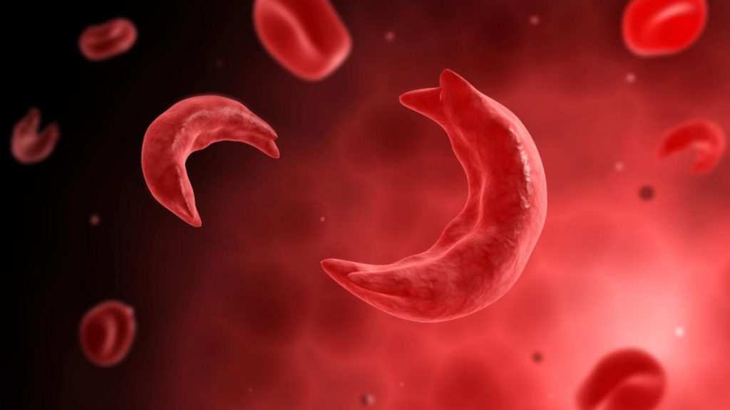 La falcemia, una condición genética que requiere cuidados