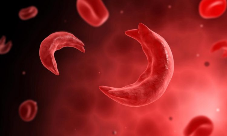 La falcemia, una condición genética que puede ser mortal La falcemia, una condición genética que requiere cuidados