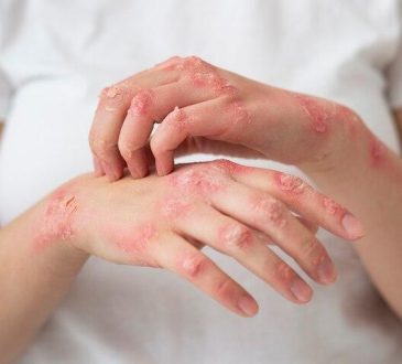 La atención temprana, clave para evitar complicaciones por contagio de lepra