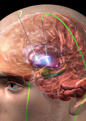 Estimulación cerebral profunda, una esperanza para pacientes con Parkinson