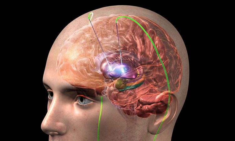 Estimulación cerebral profunda, una esperanza para pacientes con Parkinson