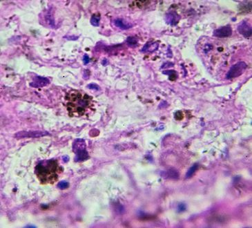 Estudio revela impacto de los genes heredados en el riesgo de melanoma